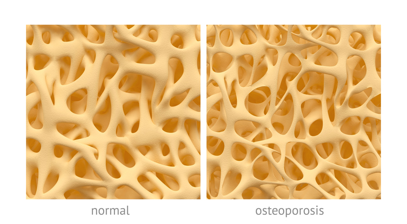 bone with normal structure and with structure in osteoporosis